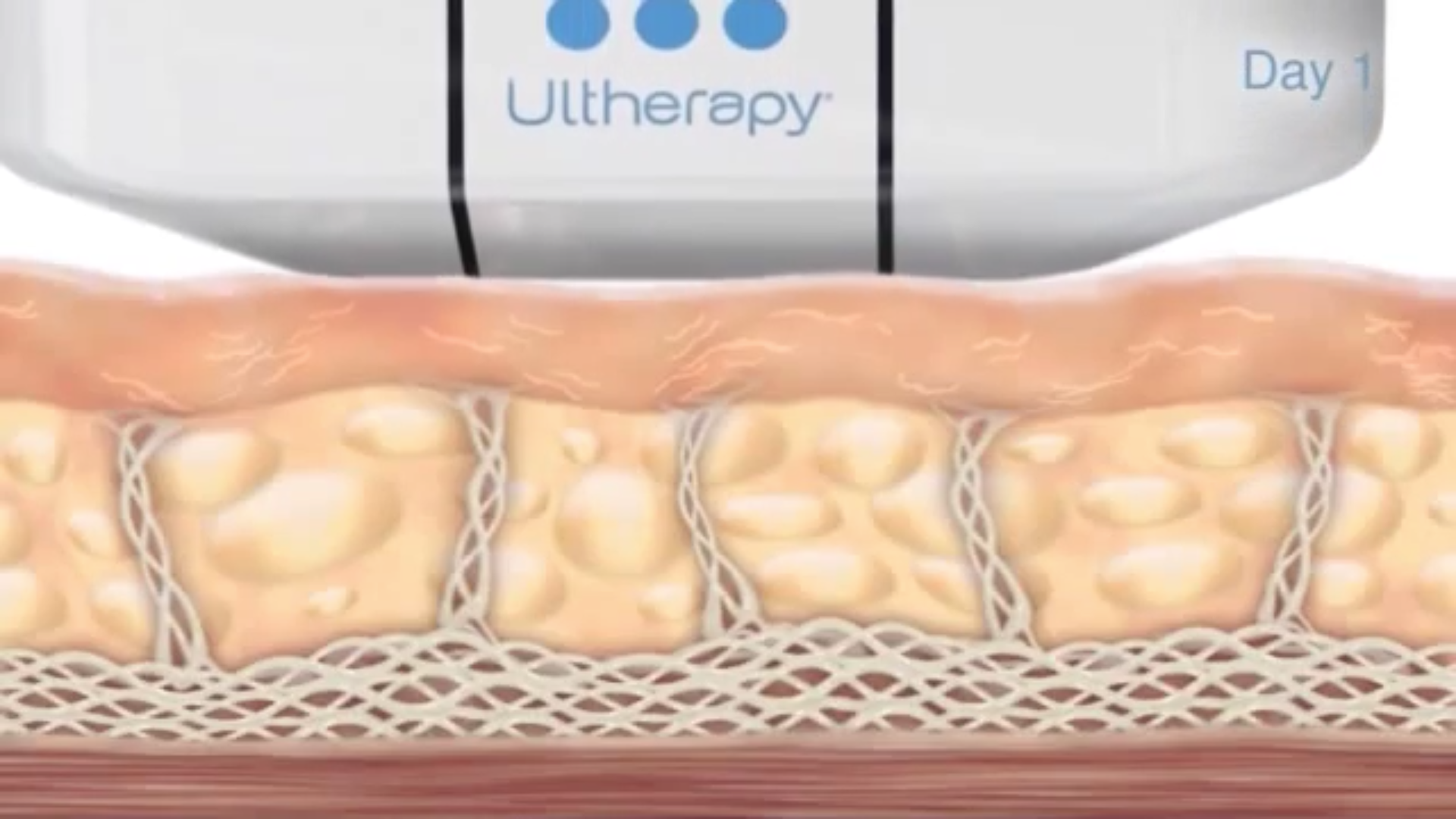 Ultherapy Video Poster